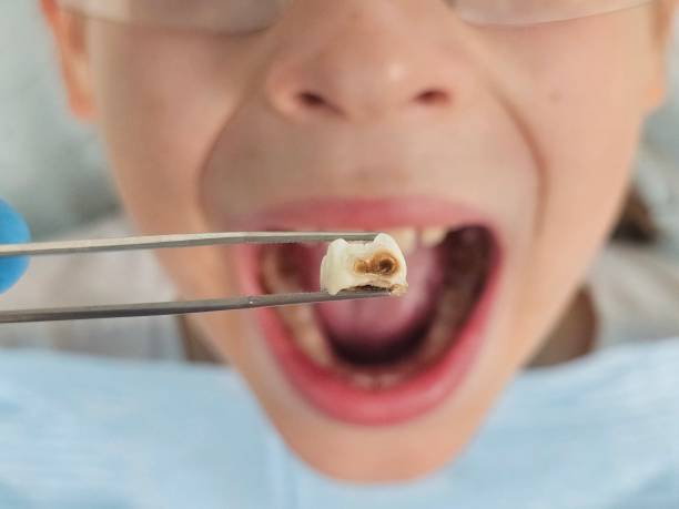 Best Emergency Tooth Extraction in Cotulla, TX